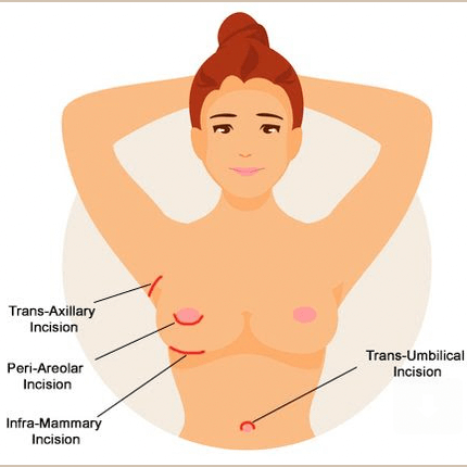 incisions